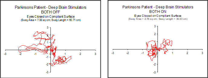 Two charts, the left showing a larger sway area for a parkinsons patient with brain stimulators on versus brain stimulators off.
