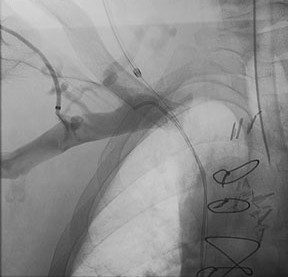Image of central chest vein