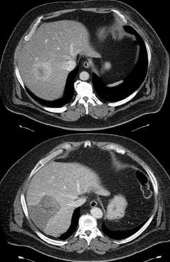 radioembolization-of-liver-tumors