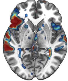 Sample fMRI activation map